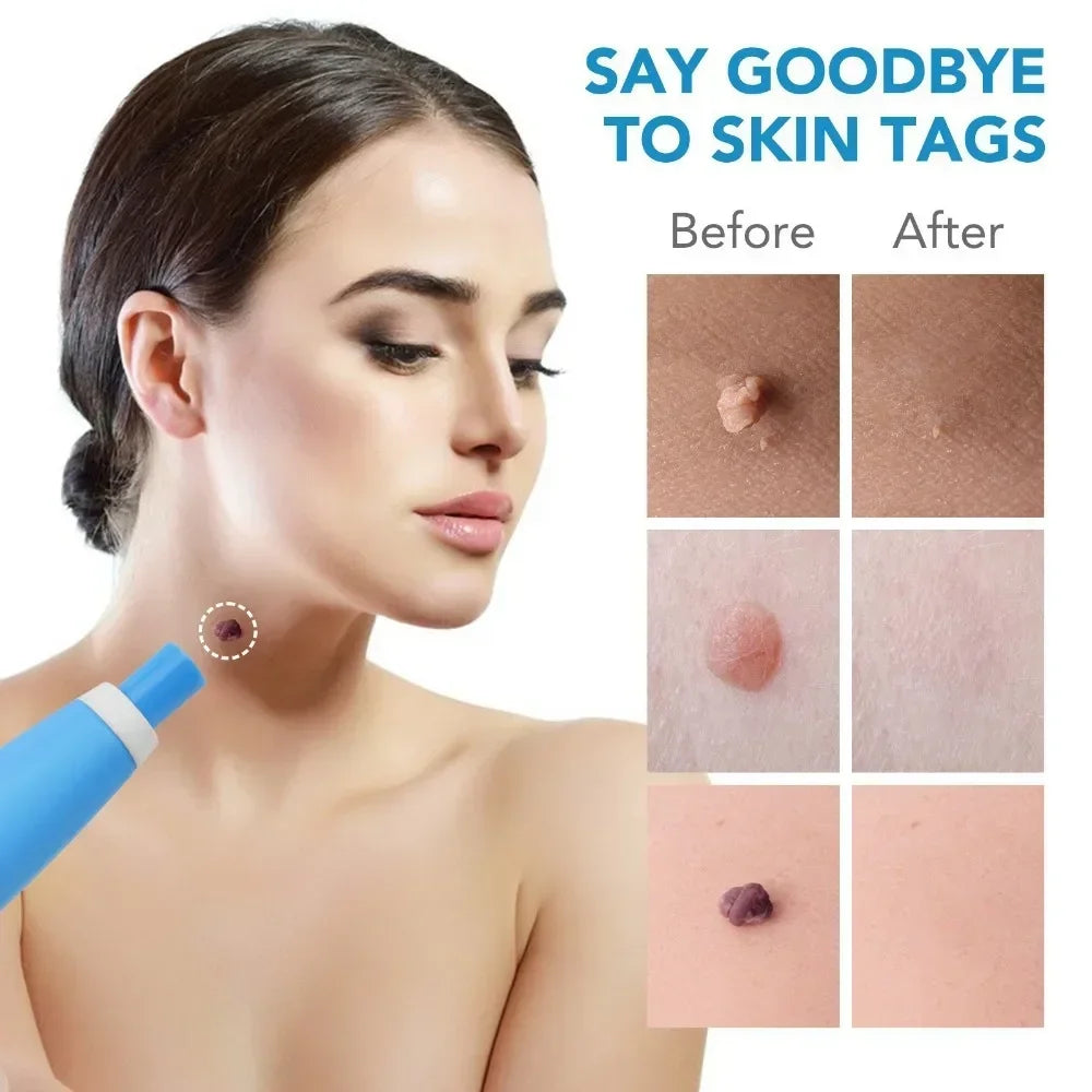 2 In1 Painless Auto Skin Tag Mole Wart Removal Kit Cleaning Tools Face Skin Care Body Wart Dot Treatments Remover Beauty Health